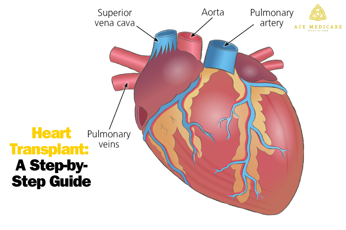 Heart Transplant: A Step-by-Step Guide